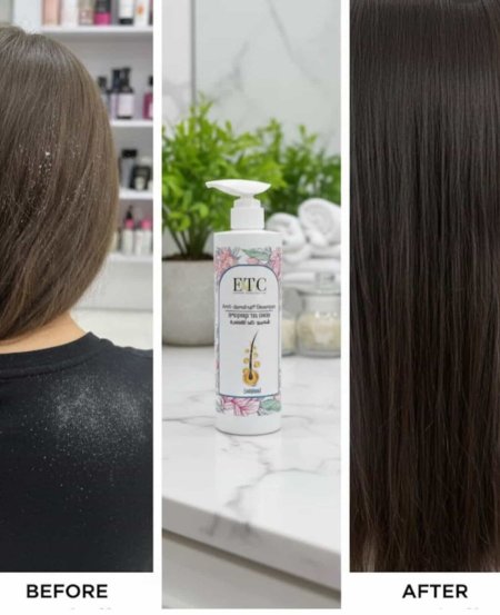 شامبو ETC للقشرة